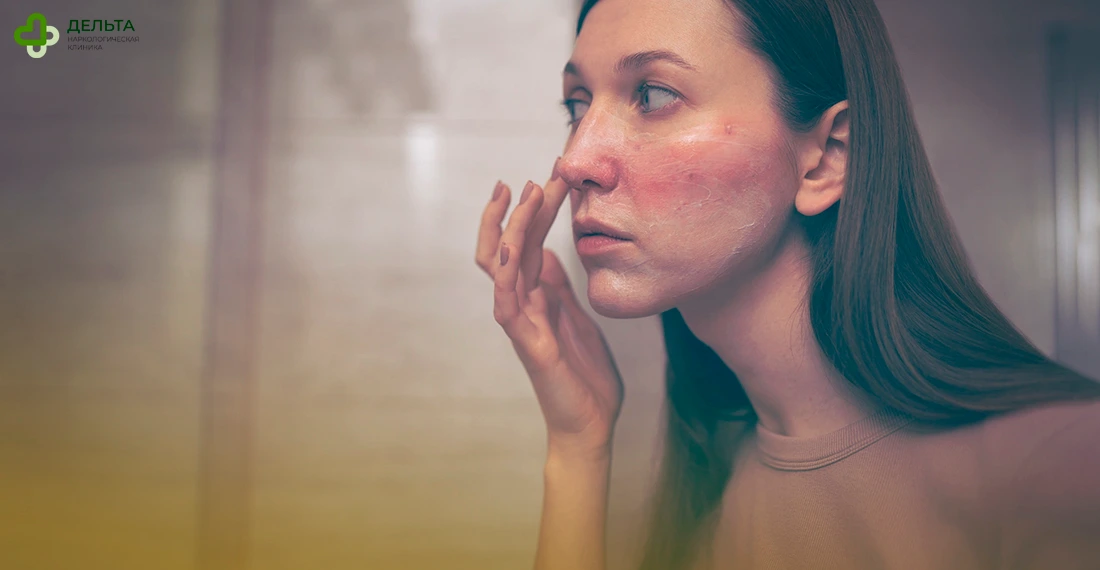 Женщина с покрасневшей кожей мажет лицо кремом